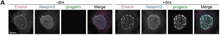 In interphase-arrested cells, progerin forms NE-associated foci that correspond to INM invaginations, whereas the ONM is unaltered. (A) Confocal images of emerin, nesprin2, and GFP-progerin in thymidine-arrested HeLa cells with and without doxycycline (dox)-induced GFP-progerin. Scale bar: 10 um. Images are representative of four experiments.