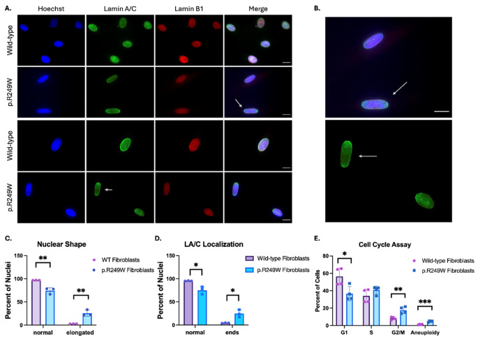 Nuclear morphology and function abnormalities are seen in patient-derived p.R249W fibroblasts. ( A ) Representative immunofluorescence images of wild-type fibroblasts and p.R249W patient-derived fibroblasts emphasizing elongation (top two panels) and Lamin A/C polar localization (bottom two panels) in p.R249W fibroblasts. Staining against Lamin A/C (green) and Lamin B1 (red) was used. ( B ) Zoom i