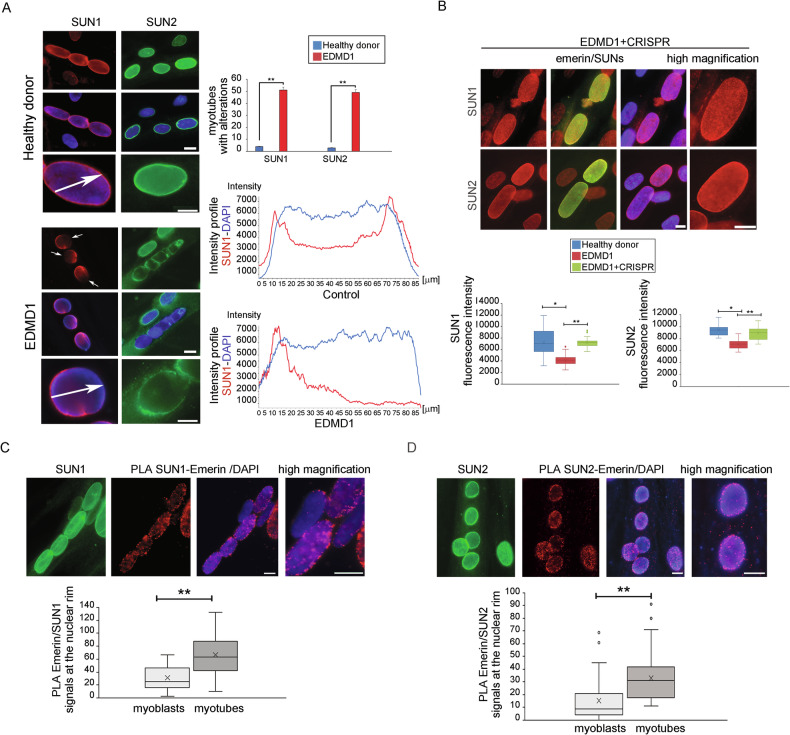 SUN1 and SUN2 mislocalization in EDMD1-myotubes nuclei. A Immunofluorescence analysis of SUN1 (red) and SUN2 (green) in myotubes from a healthy donor (Healthy donor) and EDMD1 myotubes (EDMD1). High magnification was shown in the lower panels. Percentage of myotubes with alteration of LINC complex proteins is reported in the graphs on the right ( n = 50 myotubes for sample were counted). Fluoresce