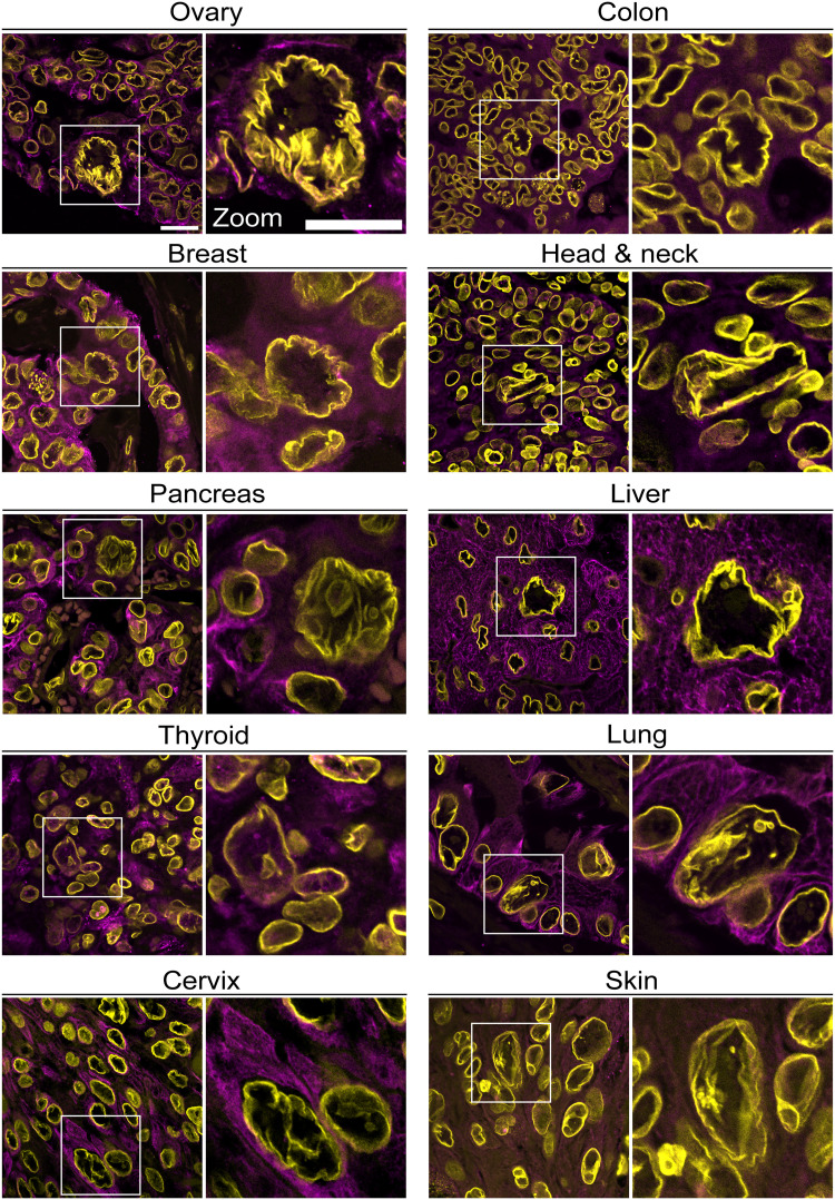 Giant nuclei in GN-PGCCs are highly wrinkled in diverse cancer patient tissues. Confocal images at 60x magnification of giant nuclei in FFPE ovarian, breast, pancreatic, thyroid, cervical, colon, head and neck, liver, lung, and skin cancer tissues stained for lamin B1 (yellow) and pan-cytokeratin (magenta). Larger images show surrounding nongiant cancer cells, with white boxes denoting zoomed regions.