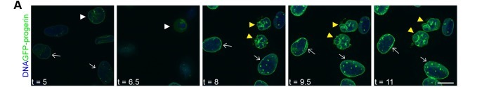 The lobulated nuclear phenotype associated with HGPS is dependent on cell division, with arrested cells displaying a distinct nuclear phenotype. (A) Time-lapse imaging of U2OS cells with doxycycline (dox)-inducible GFP-progerin expression. Cells were incubated with 500 ng/ml dox at t=0. Images were acquired every 30 min for 7 h using a spinning-disc confocal microscope. DNA was visualized using NucBlue.