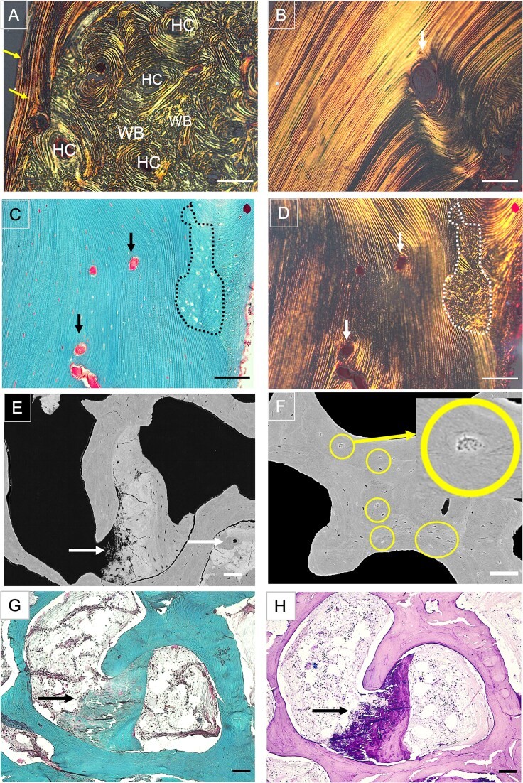 Histological section from the parallel lamellar bone in ROI 3, showing osteocyte lacunae and canaliculi in Giemsa staining. Panel (A) shows individual osteocyte lacunae with their canalicular processes extending through the lamellar matrix. Panel (B) shows the osteocyte lacuno-canalicular network (OLCN) visualized by Giemsa staining in a bone sample from a patient with pycnodysostosis, with well-preserved osteocyte morphology in the parallel lamellar region. (Homo sapiens; Figure 4.)