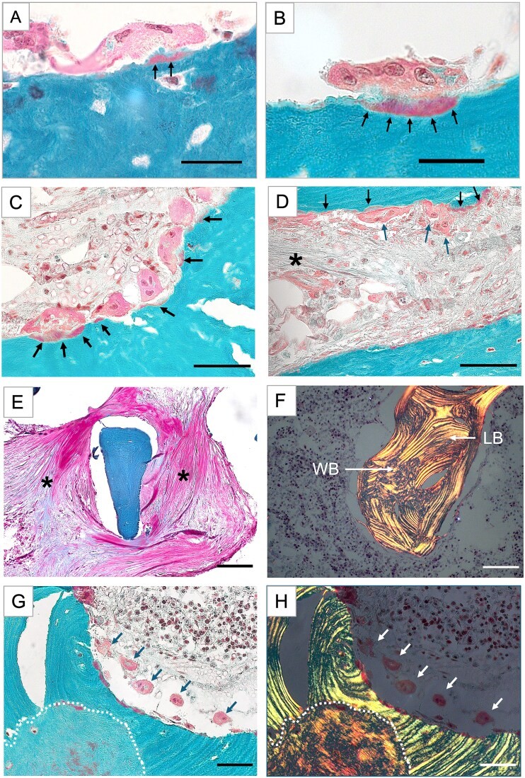 Goldner stained section of cortical bone (ROI 3) viewed under polarized light. Two distinct regions are observed: (A) a shell of primary (non-remodeled) bone formed by periosteal apposition, consisting of parallel lamellae along the periosteum, and (B) intra-cortically remodeled osteonal bone with concentrically arranged lamellae around a central Haversian canal. Osteocyte lacunae are distributed in the lamellar matrix in both regions. Human surgical bone sample from a patient with pycnodysostosis (cathepsin K deficiency). (Homo sapiens; Figure 3.)