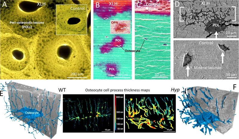 Peri-osteocytic lesions (POLs) and osteocyte cell-matrix/mineral relationships. (A) Contact microradiograph of a human bone slice showing dark, unmineralized peri-osteocytic lesions (halos) surrounding osteocyte lacunae in osteomalacic bone from a patient with X-linked hypophosphataemia (XLH). (human (iliac crest bone biopsy, X-linked hypophosphataemia); Figure 5, A.)
