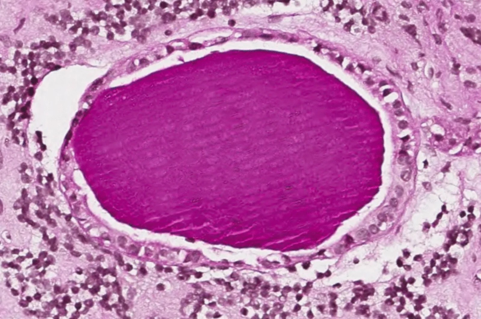 H&E stain at ×260 original magnification showing partly exfoliated cuboidal epithelial cells of a Rathke's cleft cyst and adjacent normal anterior pituitary tissue. The anterior pituitary (adenohypophysis) parenchyma comprises acidophilic cells (somatotrophs producing GH, and lactotrophs producing PRL, staining pink-red), basophilic cells (corticotrophs, thyrotrophs, and gonadotrophs, staining blue-purple), and pale chromophobe cells arranged in organoid nests separated by sinusoidal capillaries. (human (anterior pituitary, surgical specimen); Figure 5.)