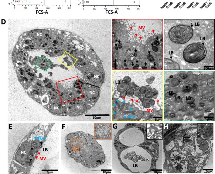 (D) Representative transmission electron microscopy (TEM) images of monocystic alveolosphere. Microvilli (MVs) observed in spheres at the apical lumen. Mitochondria (MT) displayed with blue arrow heads. A monocystic organoid from fibrotic origin displays accumulations of numerous lamellar bodies on ultrastructural level (LB, black). Black window shows intracellular LBs, while yellow and green window display extracellular LBs. High magnification images in TEM show single AT-II cell from a monocystic organoid. NC (white), MV (red arrow heads), MT (blue arrow heads) and LB (black). Scale bar = 5 µm. (E) Details of a single AT-II cell within a monocystic alveolosphere. Scale bar = 5 µm. Presence of NC, MTs, LBs and MVs. (human (primary AT-II alveolar type II cells from lung organoids); Fig. 5, panels D-E (TEM of primary human AT-II alveolosphere; rows 540-1115 of figure).)