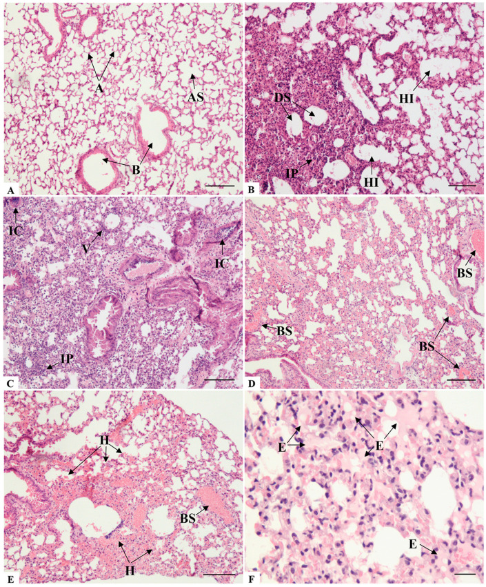Histopathological analysis of lung sections of K18-hACE2 mice inoculated with PBS (A) and infected with SARS-CoV-2 (B-F). (A) A: Alveoli; AS: Alveolar sac; B: Bronchiole. Comparatively, note the difference between the alveolar architecture of non-infected and infected mice, particularly concerning the thickening of the alveolar septa in the infected group. (B) IP: Interstitial pneumonia; DS: Dead spaces; HI: Hyperinflation. (C) IC: Inflammatory cuffing; IP: Interstitial pneumonia; V: Vasculitis. (D) BS: Blood stasis; (E) BS: Blood stasis; H: Hemorrhage; (F) E: Edema. Bar: (A-E): 100 um, (F): 50 um. (mouse (K18-hACE2, PBS control and SARS-CoV-2 infected lung sections); Figure 1.)