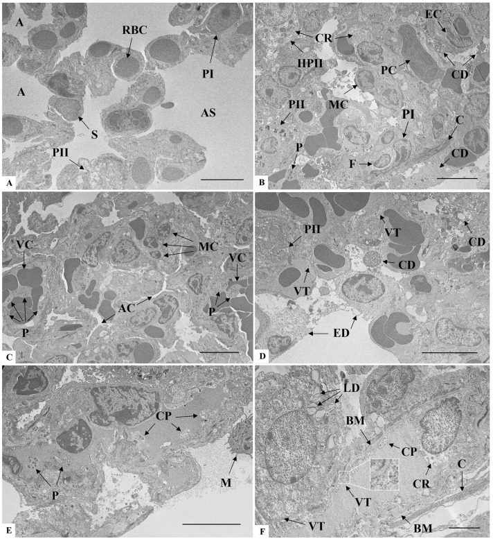 Ultrastructural analysis of lung sections of K18-hACE2 mice inoculated with PBS (A) and infected with SARS-CoV-2 (B-F). (A) A: Alveoli; AS: Alveolar sac; PI: Type I pneumocyte; RBC: Red blood cell; S: Alveolar septa. (B) C: Collagen; CD: Cellular debris; CR: Cytoplasmic rarefaction; F: Fibroblast; HPII: Hypertrophic type II pneumocyte; MC: Mononuclear inflammatory cell; P: Platelet; PII: Type II pneumocyte. (C) AC: Alveolar compression; P: Platelet; VC: Vascular congestion. (D) CD: Cellular debris; ED: Epithelial cell desquamation; PII: Type II pneumocyte; VT: Vesicle trafficking. (E) M: Macrophage; CP: Cytoplasmic protrusion; P: Platelet. (F) BM: Basal membrane thickening; C: Collagen; CP: Cytoplasmic protrusion; CR: Cytoplasmic rarefaction; LD: Lamellar bodies degeneration of type II pneumocyte; VT: Vesicle trafficking. Bar: (A-E) 5 um, (F) 2 um. (mouse (K18-hACE2 transgenic mice expressing human ACE2 under K18 promoter); Figure 4.)