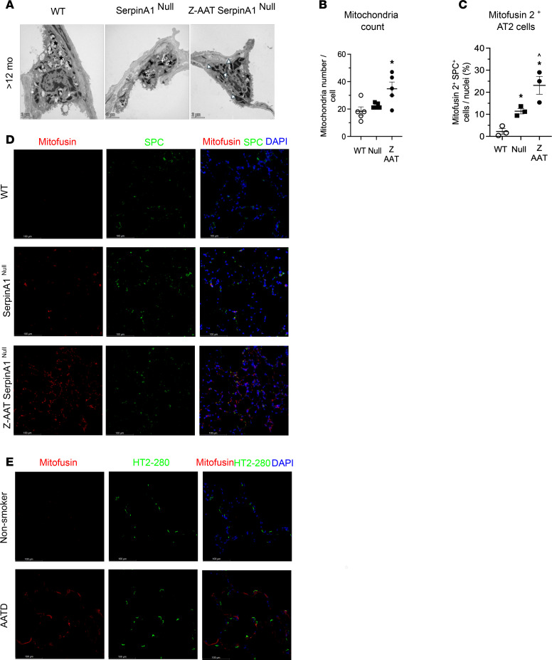 Z-AAT polymers accumulation in alveolar type-2 epithelial cells is associated with mitochondria dysfunction in Z-AAT Serpina1 Null mice and AATD lung. ( A ) Representative TEM images of in situ murine AT2 of Z-AAT Serpina1 Null , Serpina1 Null and WT mice; scale bar: 2 um. Note higher numbers of fused mitochondria (white arrows head), but unchanged number of surfactant-containing lamellar bodies (black star) in greater than 12-month-old Z-AAT Serpina1 Null versus normal mitochondria (white arrow) Serpina1 Null and WT mice. ( B ) Number of mitochondria per AT2 cell quantified by manual counting of 5 different TEM images per mouse. ( C and D ) Quantification of Mitofusin 2 (red) and pro-SPC (green) and representative immunofluorescence in lungs of 7-month-old Z-AAT Serpina1 Null , Serpina1 Null and WT mice. Colocalization Mitofusin 2 and pro-SPC (yellow) and quantified by ImageJ analysis of 5 different fields /slide from 3 different mice / genotype. Scale bar: 100 um. ( E ) Representative immunofluorescence images of healthy, never smoker and AATD lungs stained for Mitofusin 2 (red, mitochondrial marker), HTII-280 (green), and DAPI (nuclei); scale bar: 100 um. (mouse (Z-AAT Serpina1 Null, Serpina1 Null, and WT murine AT2 cells); human (healthy, never smoker, and AATD lung tissue); Figure 5.)