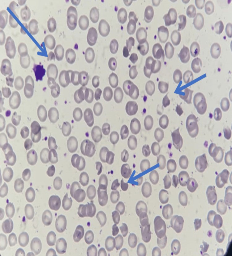 Peripheral blood film of a neonate (case 4) with infantile pyknocytosis showing moderate normocytic normochromic anemia with irregular contracted red blood cells, bite cells, and normoblasts. Pyknocytes are indicated by blue arrows. (human (neonatal peripheral blood, infantile pyknocytosis); Figure 7.)