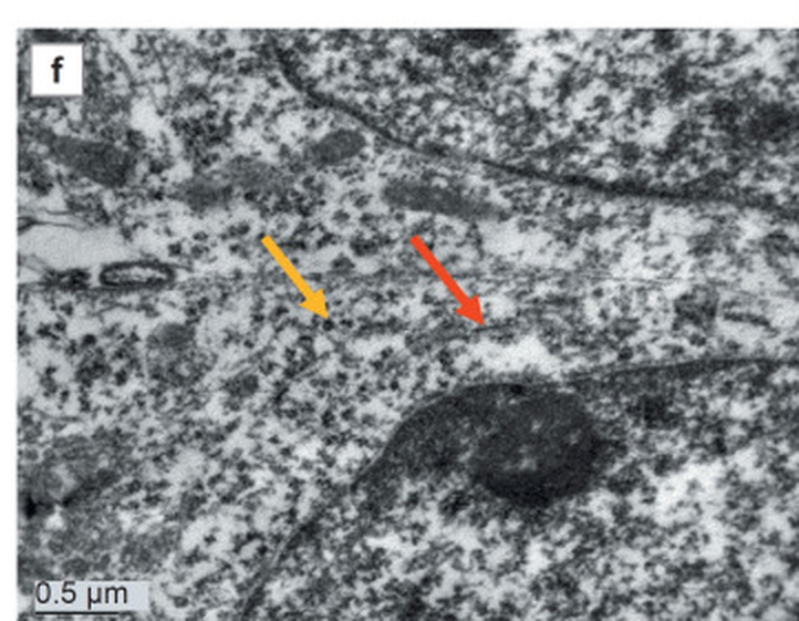 Panel of a six-part figure, cropped to this panel and otherwise unaltered, which CC BY allows with attribution. Human astrocyte differentiated from induced pluripotent stem cells of a healthy donor, 25 days in vitro. The authors describe the protein-synthesising apparatus here as polysomes, marked by the yellow arrow, with several short cisternae of rough ER at the red arrow. At a 0.5 micrometre scale bar the fine dark granules filling the cytoplasm are the ribosomes themselves: this is about as close as conventional electron microscopy brings a reader to one.