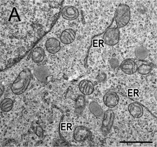 Ultrastructural aspects of ER stress in the mutant Phoenix cell line. There are long narrow ER membranes in control Phoenix line (A) and straight rigid ER membranes and dilated ER cistern lumen in mutant Delta2-4VPS13B#4, #5, 11, #24 and #25 (B, C) clones. These ER membrane changes also extended to the nuclear envelope (D, E). Scale bar: 1 um. ER--endoplasmic reticulum. (human (Phoenix cells); Figure 6A.)