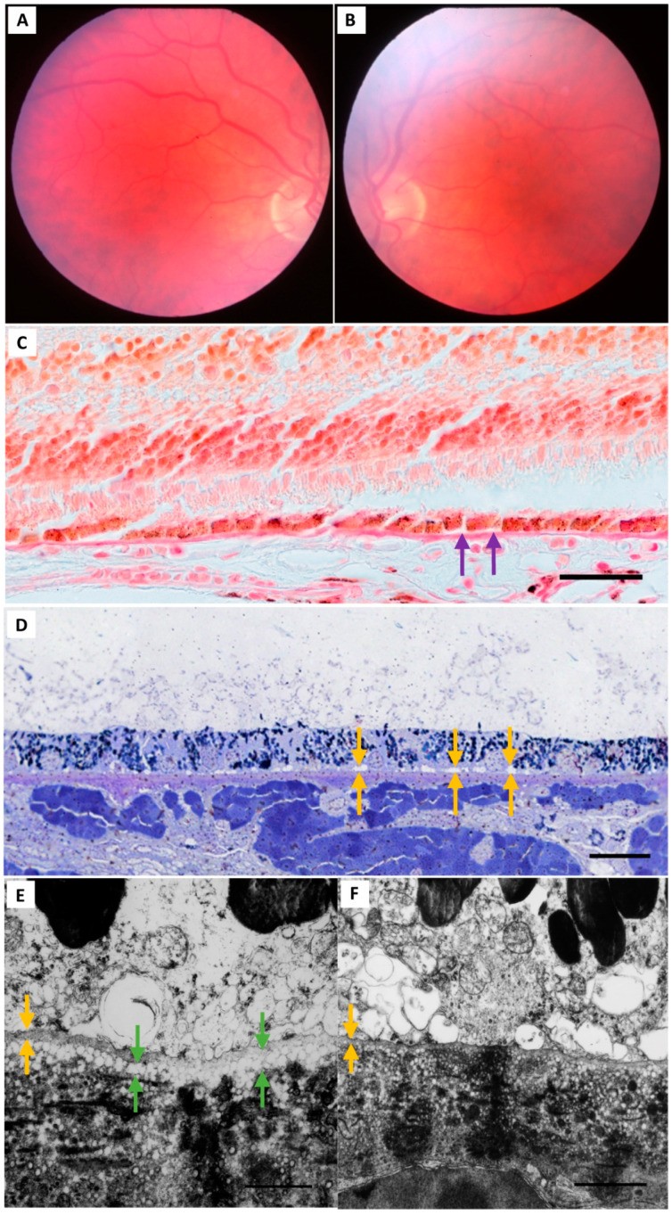 Group I (normal) human eye: representative retinal pigment epithelium (RPE) TEM micrograph from a 55-year-old male with normal bilateral fundus examination. Macular sections showing normal RPE ultrastructure with Bruch's membrane (BrM), RPE cell body, apical microvilli, and melanosomes. (Homo sapiens; Figure 1.)