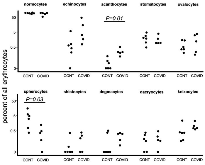 Low-vacuum scanning electron microscopy (LVSEM) images of erythrocyte morphological types from five patients with severe COVID-19. The panel shows a spectrum of poikilocytes associated with COVID-19 microangiopathy, including schistocytes (fragmented erythrocytes) alongside echinocytes and other abnormal red blood cell forms. Scale bar equals 3 micrometres. (human (severe COVID-19); Figure 3.)