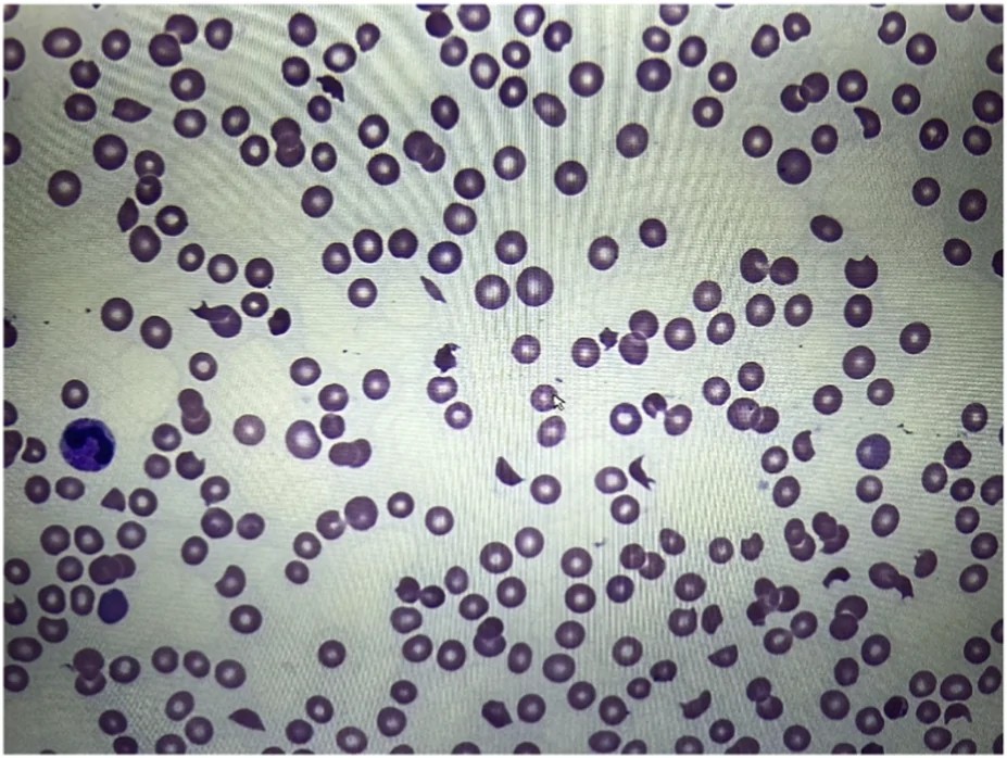 Peripheral blood smear revealing schistocytes in severe immune thrombotic thrombocytopenic purpura (iTTP). Fragmented red blood cells characteristic of microangiopathic hemolytic anemia. (human (peripheral blood, immune-mediated TTP); Figure 1.)