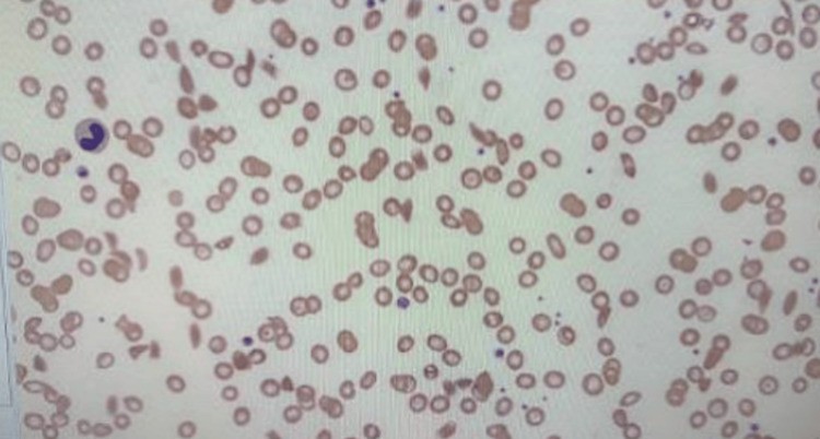 Peripheral blood smear showing sickled erythrocytes consistent with hemoglobin SS sickle cell disease in a patient presenting with aplastic crisis triggered by Parvovirus B19. No schistocytes or other abnormal red cell morphologies noted. Wright-Giemsa stain, 1000x magnification. (human (peripheral blood, sickle cell disease HbSS); Figure 1.)