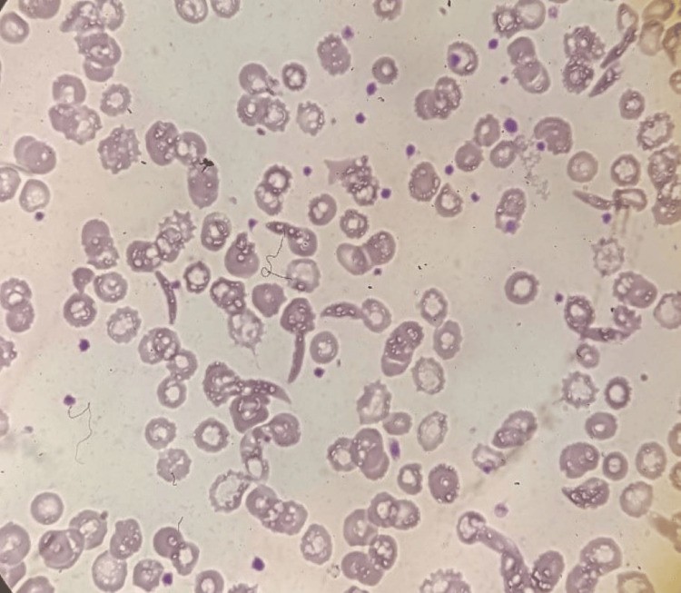 Peripheral blood smear showing marked anisopoikilocytosis with sickle cells (drepanocytes) in a patient with sickle cell-beta thalassemia. Elongated, crescent-shaped erythrocytes characteristic of haemoglobin S polymerisation are visible alongside target cells and other poikilocytes. (human (peripheral blood, sickle cell-beta thalassemia); Figure 3.)