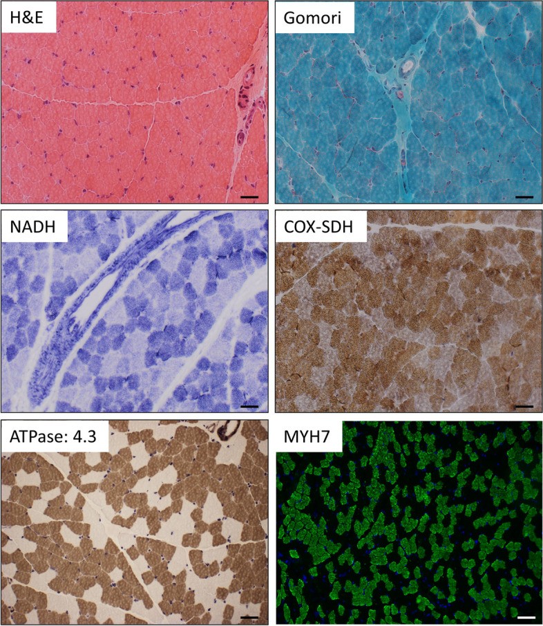 H&E (top left) and Gomori trichrome stain (top right) of human skeletal muscle showing normal morphology — well-defined polygonal fibres with peripheral nuclei, no significant fibre size variation or necrosis. NADH and COX-SDH stains (bottom) show mitochondria distribution. Biopsy from a child with Pitt-Hopkins syndrome (TCF4 mutation); H&E and Gomori morphology reported as normal. (human (child with Pitt-Hopkins syndrome/TCF4 mutation; normal H&E morphology); Figure 2.)