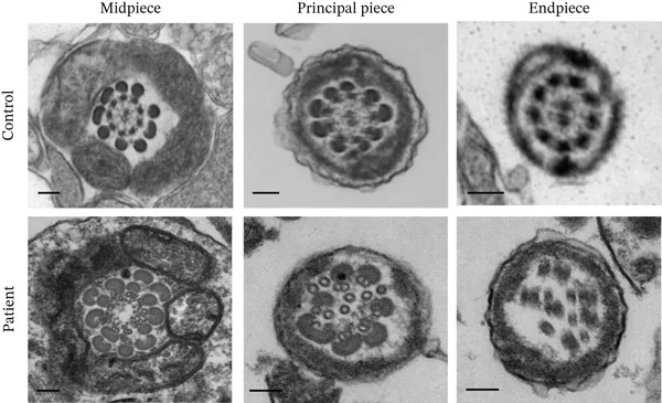 Ultrastructural flagellar abnormalities in the patient. Representative TEM micrographs showing cross sections of the midpiece, principal piece, and end piece of sperm flagella from a fertile control and the patient. Scale bars represent 100 nm. (Figure 5.)
