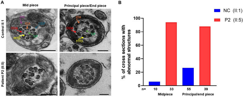 Ultrastructural abnormalities in sperm flagella revealed by transmission electron microscopy. A TEM analysis of sperm flagella from patient P2 (II:5) showing severely disorganized or absent axonemal microtubule doublets (DMTs). The axoneme structure in control presents a '9 + 2' microtubules arrangement, including mitochondrial sheath (MS, indicated with plum arrow), central pair of microtubules (CP, indicated with green arrow), outer dense fibers (ODFs, indicated with turquoise arrow), peripheral doublet microtubules (DMTs, indicated with yellow arrow), inner dynein arm (IDA, indicated with orange arrow), and outer dynein arm (ODA, indicated with red arrow) scale bars, 500 nm. B Quantification of abnormal axonemal cross-sections in patient P2 (II:5) compared to an unaffected control brother (II:1). (Fig. 3.)