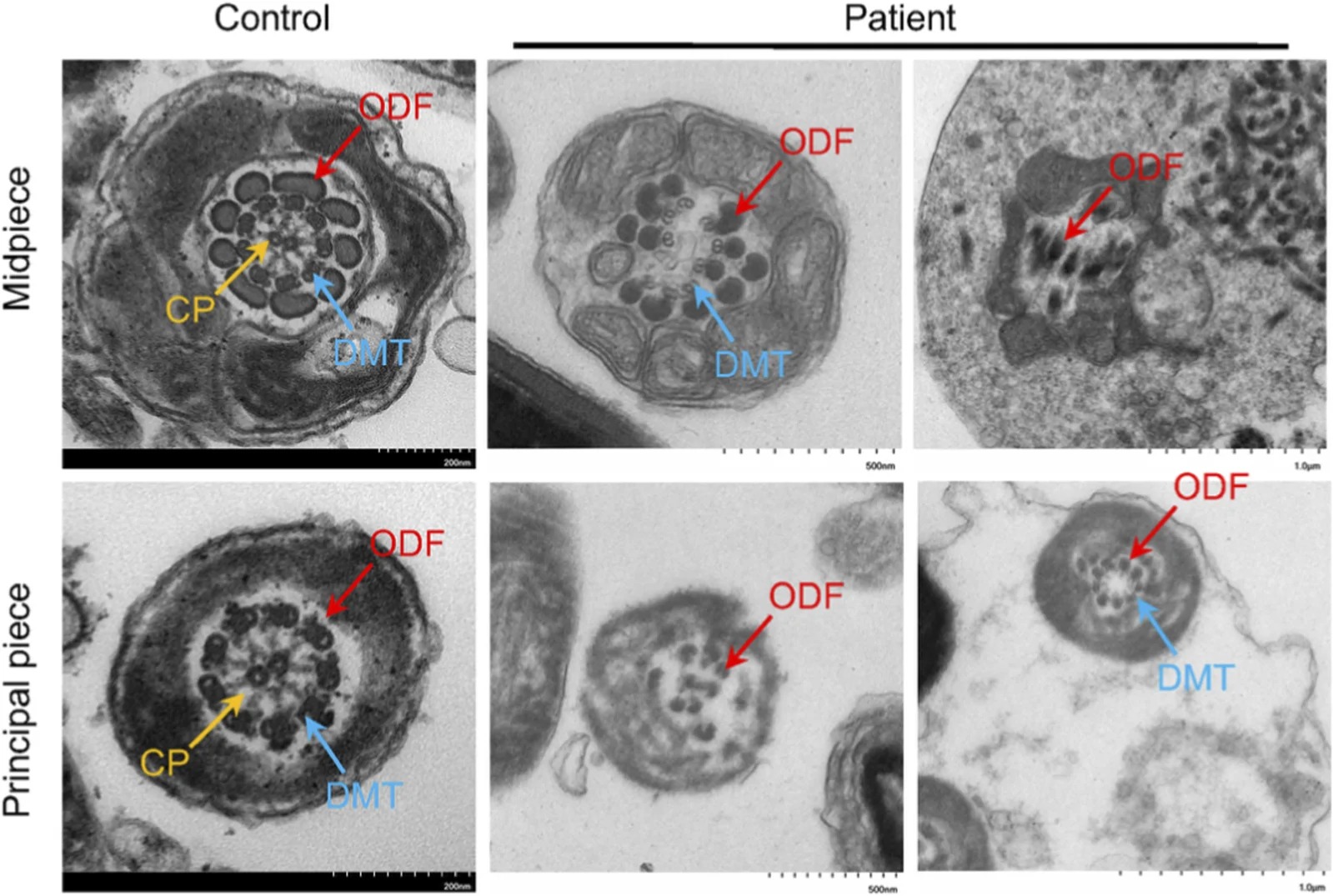 Transmission electron microscopy analysis of sperm flagellar ultrastructure. Representative transverse sections of the midpiece and principal piece from a fertile control and the proband are shown. Control sperm flagella exhibited the canonical "9 + 2" axonemal organization, whereas sperm flagella from the proband showed loss or poor definition of the central pair, loss or disorganization of peripheral doublet microtubules, and abnormal arrangement of outer dense fibers. Yellow arrows indicate the central pair (CP), blue arrows indicate peripheral doublet microtubules (DMTs), and red arrows indicate outer dense fibers (ODFs). (FIGURE 3.)
