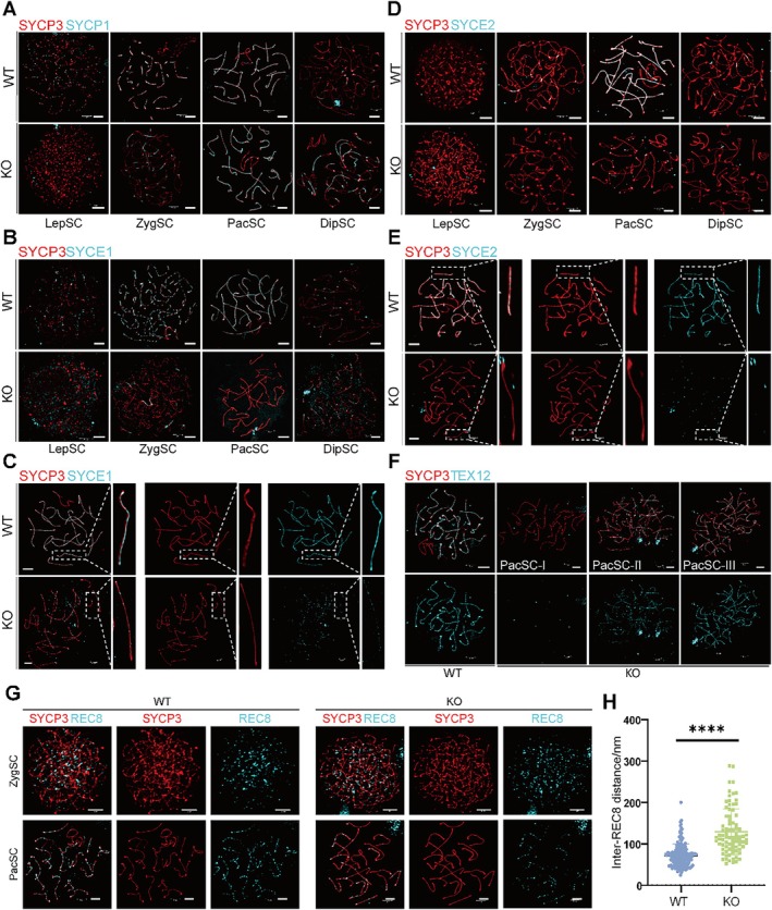 The structure of SC of spermatocytes in WT and Sox30 KO mice. (A) Co-immunofluorescence stain of SYCP3 (red) and SYCP1 (cyan) in chromosome spreads of spermatocytes from WT and KO mice (scale bar: 3 um). (B, C) Co-immunofluorescence stain of SYCP3 (red) and SYCE1 (cyan) in chromosome spreads of spermatocytes from WT and KO mice and the magnified view (scale bar: 3 um). (D, E) Co-immunofluorescence stain of SYCP3 (red) and SYCE2 (cyan) in chromosome spreads of spermatocytes from WT and KO mice and the magnified view (scale bar: 3 um). (F) Co-immunofluorescence stain of SYCP3 (red) and TEX12 (cyan) in chromosome spreads of spermatocytes from WT and KO mice (scale bar: 3 um). (G) REC8 (cyan) and SYCP3 (red) co-localization patterns in Sox30 KO spermatocytes. KO cells show discontinuous REC8 linear arrays (arrowheads) compared to WT. Scale bar: 3 um. (H) Quantification of inter-REC8 focus distances. Sox30 KO cells exhibit increased spacing (**** p < 0.0001, n = 167 cells from 3 mice for WT group, n = 81 cells from 3 mice for KO group, Student t test). DipSC: diplotene; LepSC: leptotene; PacSC: pachytene; ZygSC: zygotene. (mouse (spermatocytes from wild-type and Sox30 knockout mouse testes; meiosis I stages); Figure 3.)