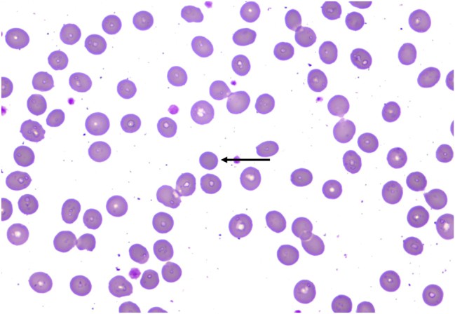Peripheral blood smear (x1000 magnification): Spherocytes (indicated by arrows). Dense, small, round erythrocytes lacking central pallor in a patient with lymphoplasmacytic lymphoma-associated autoimmune hemolytic anemia. (human (peripheral blood, AIHA secondary to lymphoplasmacytic lymphoma); Figure 1.)