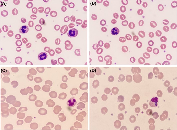 Cytomorphological examination of peripheral blood (panel A). A large number of stomatocytes can be seen in the blood smear. Overhydrated hereditary stomatocytosis (OHSt) caused by heterozygous RHAG gene mutation. Stomatocytes show a characteristic mouth-shaped (stoma) central pallor. (human (peripheral blood, overhydrated hereditary stomatocytosis); Figure 1, A.)
