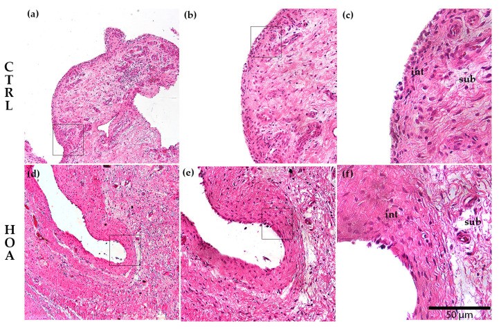 Haematoxylin and eosin (H&E)-stained sections of human synovial tissue from control (normal) hip and hip osteoarthritis (HOA). The control synovial membrane (left panels) shows a thin intima consisting of 1 to 3 layers of fibroblast-like synoviocytes (type B synoviocytes) overlying a loose sublining stroma. In osteoarthritis (right panels), the intima is thickened with increased synoviocyte layers and subintimal cellular infiltrates. Low and high magnification panels shown. (human (hip joint synovium); Figure 2, a-f.)