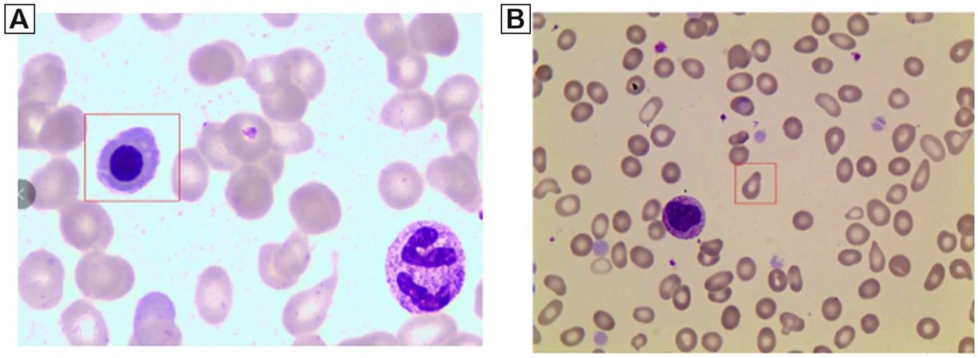 Peripheral blood smear from a patient with primary myelofibrosis showing (A, left box) a nucleated erythrocyte (normoblast) and (B, right box) a teardrop-shaped erythrocyte (dacryocyte). Dacryocytes have an elongated teardrop shape with one rounded and one pointed end, forming when erythrocytes are deformed while being squeezed past fibrous tissue in the bone marrow. Wright-Giemsa stain. (human (primary myelofibrosis); Figure 2, A-B.)