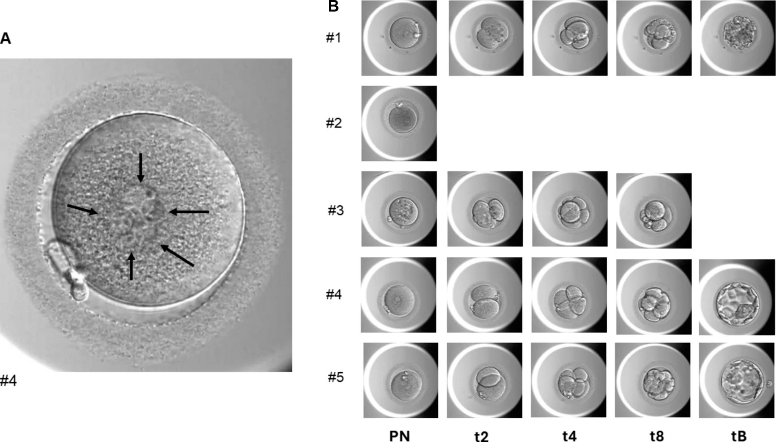 Pronuclear assessment and time-lapse development of embryos from the reported cycle. A Representative image of the five-pronuclear (5PN) zygote; arrows indicate the five pronuclei. B Time-lapse images of embryos #1-#5 at key developmental time points: pronuclear stage (PN), 2-cell (t2), 4-cell (t4), 8-cell (t8), and blastocyst (tB) (times annotated relative to ICSI, t0). Embryo #1 arrested at the early blastocyst stage (Gardner stage 2), Embryo #2 arrested after the PN stage, #3 arrested at cleavage stage, whereas embryos #4-#5 progressed to blastocyst (human (clinical IVF cycle, ICSI-fertilized zygotes including a 5PN case resulting in live birth); Fig. 1.)