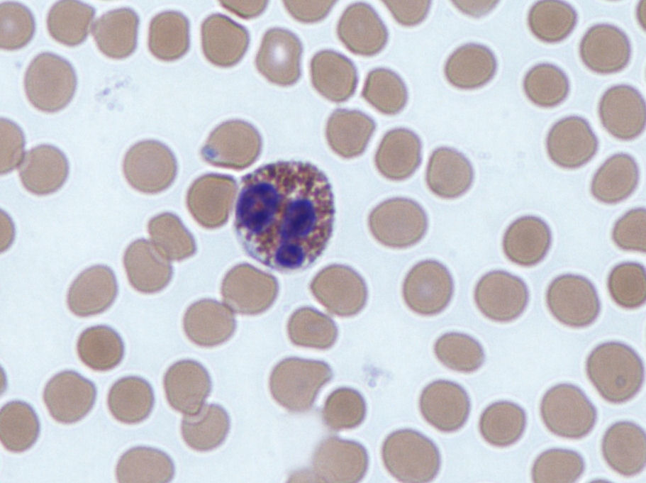 Eosinophil in a Giemsa-stained peripheral blood smear, showing characteristic bilobed nucleus and pink-orange specific granules.