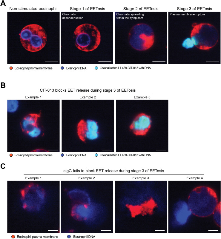 CIT-013 blocks EET release when plasma membrane integrity is compromised. (A) Representative immunofluorescence images of a non-stimulated eosinophil or eosinophils triggered for EETosis with 2 uM A23187 in the presence of HiLyteTM Fluor 488-conjugated CIT-013 (HL488-CIT-013). The eosinophils activated for EETosis showed chromatin decondensation and a re-organized rounded nucleus in stage 1 of EETosis, nuclear membrane rupture and chromatin spreading within the cytoplasm in stage 2 of EETosis, and plasma membrane rupture and CIT-013 binding to chromatin in stage 3 of the EETosis pathway. Of note, due to technical limitations we were not able to clearly track one specific eosinophil over time and therefore different eosinophils at each stage of the EETosis pathway are shown. (B) More representative immunofluorescence images of eosinophils triggered for EETosis with A23187 in the presence of HiLyteTM Fluor 488-conjugated CIT-013. (C) Representative immunofluorescence images of eosinophils triggered for EETosis with A23187 in the presence of HiLyteTM Fluor 488-conjugated isotype control antibody (HL488-cIgG). Scale bars are 10 um.