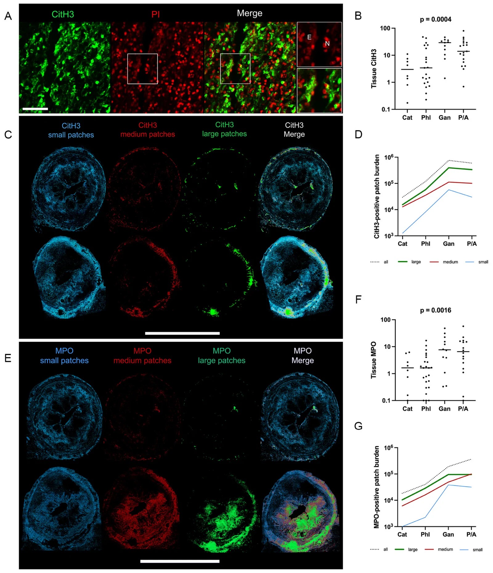 CitH3 stage-dependently forms extended larger patches in advanced appendicitis. (A) Representative immunofluorescence image demonstrates CitH3 (green) in spatial association with extracellular DNA (propidium iodide; red) in inflamed appendiceal tissue. Insets show magnified views of the boxed regions and highlight nuclear [N] and extracellular DNA [E]. Scale bar: 100 um. (B) Quantification of CitH3 across catarrhal (Cat, n = 9), phlegmonous (Phl, n = 21), gangrenous (Gan, n = 11), and perforated/abscess appendicitis (P/A, n = 19). (C) Representative images of entire wall of vermiform appendix illustrating size-based segmentation of CitH3-positive patches in catarrhal (Cat) and gangrenous (Gan) appendicitis. Scale bar: 1 cm. (D) Quantification of CitH3 patches stratified by patch size. (E) Representative images of entire wall of vermiform appendix illustrating size-based segmentation of MPO-positive patches in catarrhal (Cat) and gangrenous (Gan) appendicitis. Scale bar: 1 cm. (F) Quantification of MPO across catarrhal (Cat, n = 9), phlegmonous (Phl, n = 21), gangrenous (Gan, n = 11), and perforated/abscess appendicitis (P/A, n = 19). (G) Quantification of MPO patches stratified by patch size.