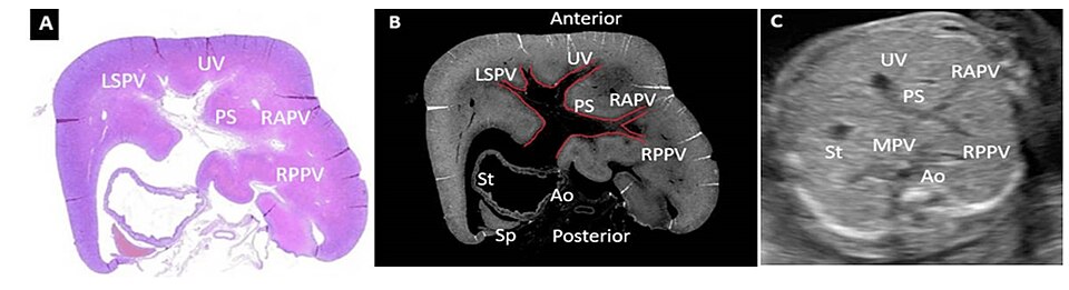 Figure 7. Histopathological and ultrasound aspect of normal FT liver. (A): Normal histological appearance of the FT liver, demonstrating the UV, LSPV, PS, RAPV, RPPV. Classic hematoxylin-eosin staining, ×100