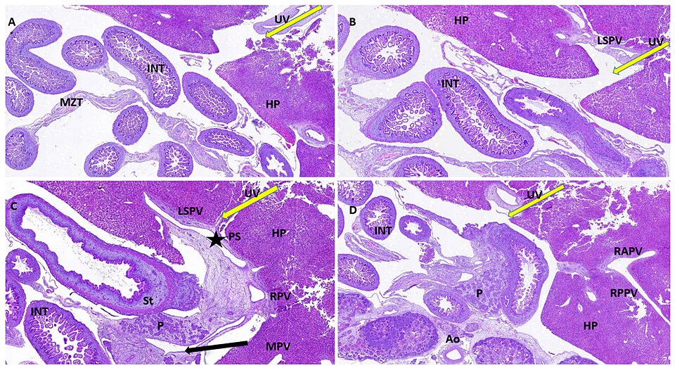 Figure 6. Histological appearance of the FT liver with normal PVS. (A): Histopathological aspect of FT fetal liver. It is observed how UV enters the hepatic structure (yellow arrow) and reaches its visceral surface near the intestinal loops