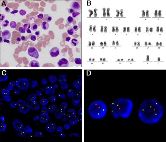 (A) Bone marrow cytomorphology by bone marrow aspirate smear. (B) Karyotype of bone marrow. (C) FISH probe detection of myeloid sarcoma biopsies. (D) FISH probe detection of bone marrow aspirate.