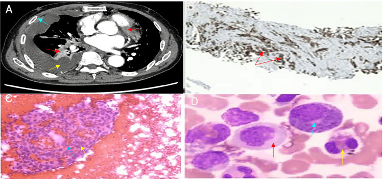 Radiologic, histopathologic, cytologic, and bone marrow findings (A) Contrast-enhanced chest CT demonstrates a large mass in the right hilar region (red arrow), accompanied by a large right-sided malignant pleural effusion (yellow arrow) and significant pleural thickening (blue arrow). (B) Immunohistochemical staining of the pleural biopsy specimen reveals strong nuclear positivity for TTF-1 in tumor cells (brown staining, red arrows), confirming an origin of lung adenocarcinoma. (C) Pleural effusion cytology (H&E stain) reveals clusters of adenocarcinoma cells against a hemorrhagic background, exhibiting enlarged, hyperchromatic nuclei and marked atypia (blue and yellow arrows). (D) Bone marrow smear demonstrates marked granulocytic hyperplasia. Myeloblasts (red arrow), plasma cells (blue arrow), and mature eosinophils (yellow arrow) are visible, features consistent with a paraneoplastic leukemoid reaction. CT: computed tomography; TTF-1: thyroid transcription factor-1; H&E: hematoxylin and eosin