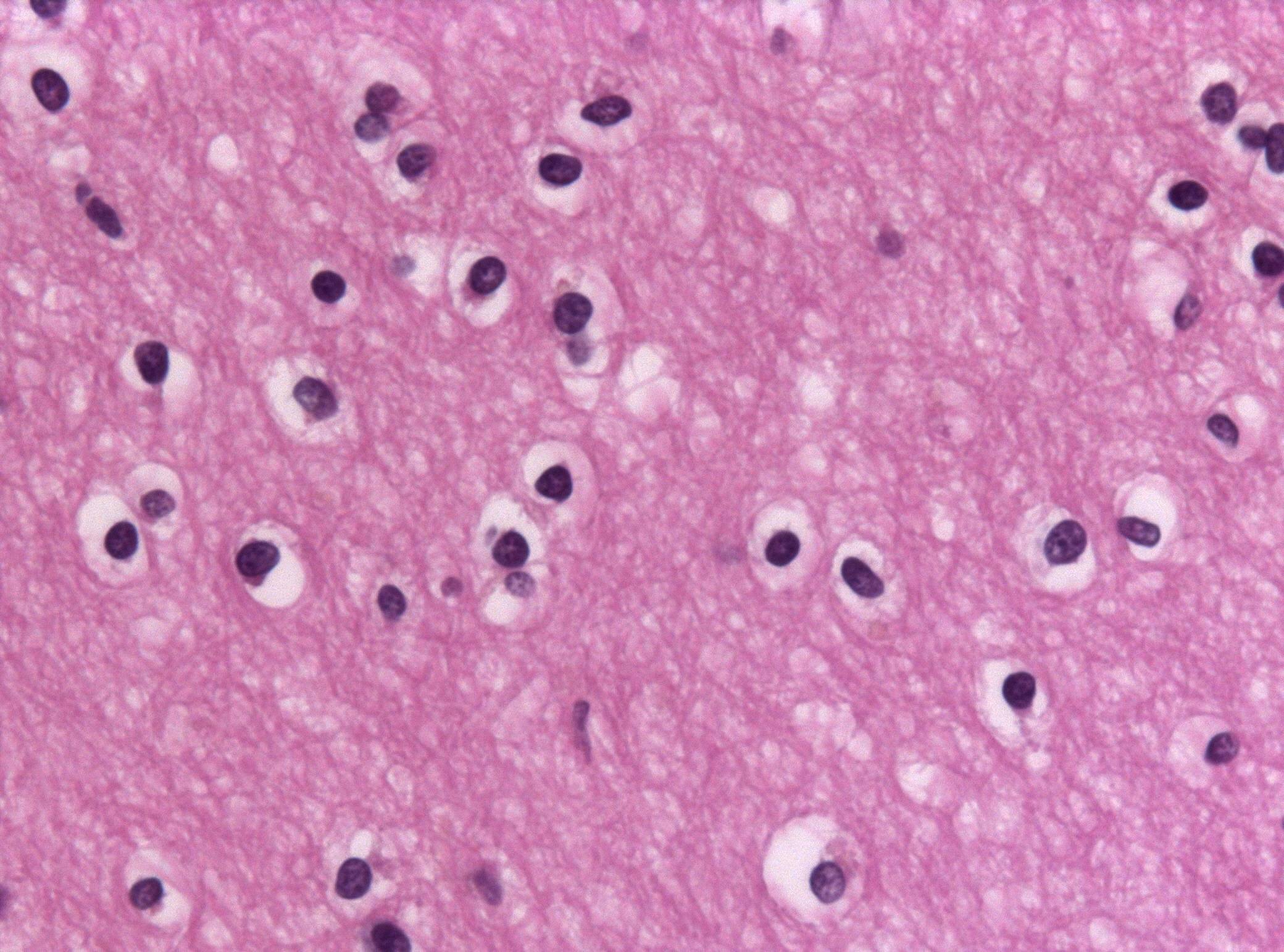 H&E stain of human brain autopsy tissue (formalin-fixed, paraffin-embedded) showing oligodendrocytes with the classic fried-egg appearance: round pale perinuclear halo from formalin fixation artefact, small dark nucleus. High magnification.