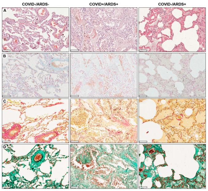 Representative images of lung tissue specimens with (A) hematoxylin eosin staining, (B) alcian blue staining, (C) Elastica van Gieson and (D) Masson-Goldner staining of COVID–/ARDS–, COVID+/ARDS+ and COVID–/ARDS+ patients. Scale bar 100 µm.