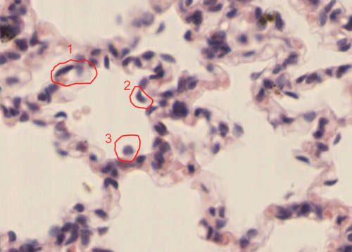 Photomicrograph showing alveolus cell types. 1 - Type II alveolar epithelial cell (type II pneumocyte). 2 - Type I alveolar epithelial cell (type I pneumocyte). 3 - Alveolar macrophage (alveolar macrophage; dust cell).