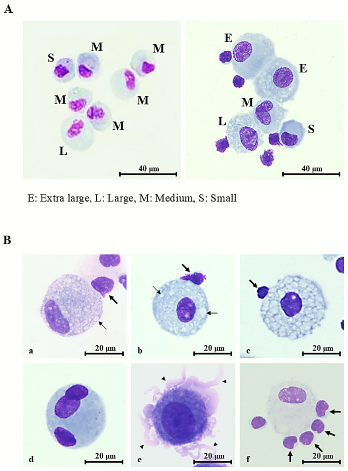 Representative morphologic features of alveolar macrophages in healthy controls and sarcoidosis. (A) Representative Diff-Quik®–stained images of alveolar macrophages (AMs) in bronchoalveolar lavage fluid specimens (scale bar = 40 μm, shown in figure). E, extra-large; L, large; M, medium; S, small. (A, left panel) Healthy individual: AM measuring 15–20 μm in diameter, with faintly basophilic cytoplasm and elongated, thin nuclei displaying unevenly distributed chromatin. Occasional cytoplasmic vacuoles are present. (A, right panel) Sarcoidosis patient: AMs enlarged to 20–30 μm with bright basophilic cytoplasm, round nuclei exhibiting relatively uniform chromatin, and prominent nucleoli. Numerous vacuolated AMs and lymphocyte attachment to the AM surface (rosette formation) are also observed. (B) Typical morphological features of sarcoidosis AMs (scale bar = 20 μm, shown in figure).