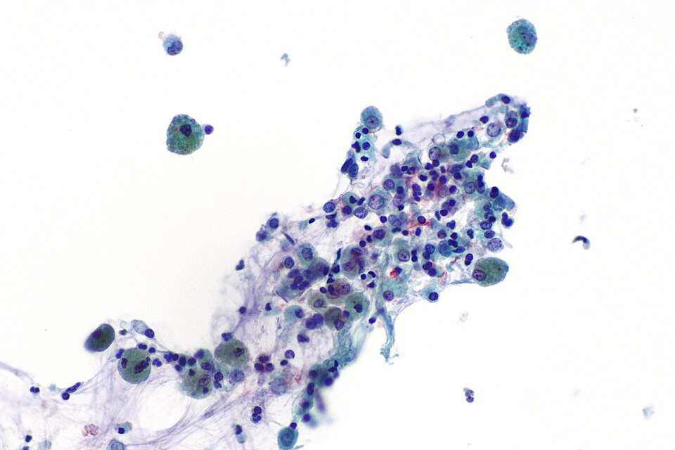 Micrograph showing hemosiderin-laden macrophages (also siderophages) in a bronchoalveolar lavage (BAL) specimen.