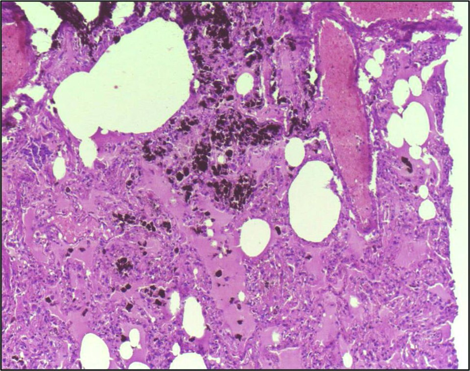 Lung tissue showing collections of alveolar macrophages with phagocytosed blackish pigment, carbon, without evoking an inflammatory response in the surrounding tissue. H&E stain 4X.