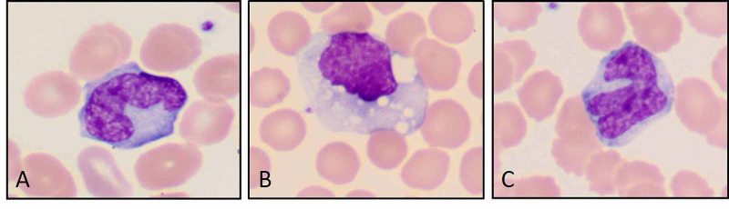 Activated macrophages with abnormal shapes and cytoplasmic vacuolization. (Original magnification ×1000 oil immersion {A through C}.)
