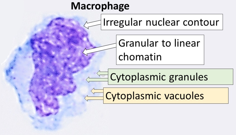 Cytology of a macrophage with typical features. Wright stain. Sample from cerebrospinal fluid.