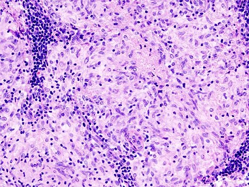 Histopathological image of sarcoidosis. Lymph node biopsy. Note epithelioid granuloma. H & E stain.