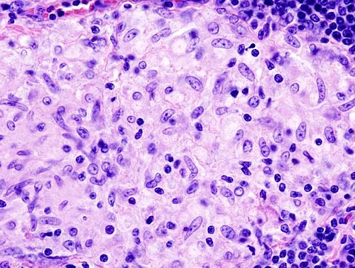 Histopathological image of sarcoidosis. Lymph node biopsy. Note epithelioid granuloma with asteroid bodies, which appear obscure. H & E stain.