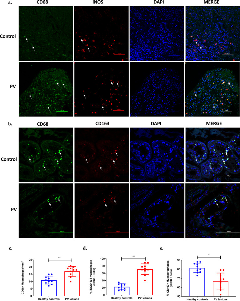 Macrophages and their subtypes in PV lesional tissues. Representative confocal microscopic images of M1 and M2 macrophages in control and PV tissue. (a) M1 phenotypic cells are shown as cells which are CD68+ (green) and iNOS+ (red). Tissue sections were stained with primary antibody CD68 conjugated with anti-mouse FITC labelled secondary antibody (green), primary antibody iNOS conjugated with anti-rabbit Alexa fluor 550 labelled secondary antibody (red) and DAPI mounting media =blue. The dilution used for CD68 was standardised at 1:100 and for iNOS at 1:200. Images were captured at 40x magnification. Scale bar= 50 um. (b) M2 phenotypic cells are shown as cells which are CD68+ (green) and CD163+ (red). Tissue sections were stained with primary antibody CD68 conjugated with anti-mouse FITC labelled secondary antibody (green), primary antibody CD163 conjugated with anti-rabbit Alexa fluor 550 labelled secondary antibody (red) and DAPI mounting media =blue. The dilution used for CD163 was standardised at 1:200. Images were captured at 60x magnification. Scale bar= 100 um. (c-e) Column bar graph representing MFI (mean fluorescent intensity) of macrophages and their subtypes calculated using ImageJ software. ***p<0.001, **p<0.005, *p<0.05, n= 10.