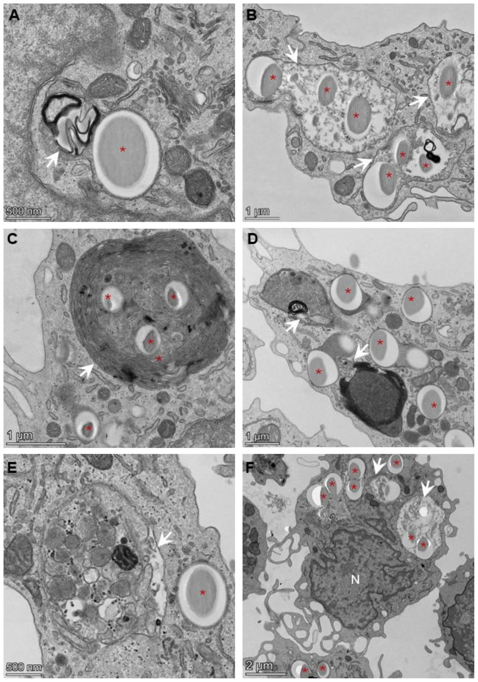 Ultrastructural features of MNP-containing vacuoles and associated remodeling of degradative vacuolar hubs with autophagic features. (A-F) Representative TEM images of human monocytes exposed to MNPs at 24 or 72 h. (A) MNP-containing phagosome surrounded by multilamellar membrane structures (lamellar whorls; arrow). (B) Multiple intracellular MNP-containing vacuoles (arrows), displaying heterogeneous morphology and electron density. (C) Prominent multilamellar body (arrow) adjacent to MNP-containing compartments. (D) Coexistence of MNP-containing phagosomes (arrows) with vacuolar structures of variable size and content, including early and late phagolysosomal compartments. (E) Giant degradative vacuolar compartment (arrow) resembling an autolysosome/phagolysosome, containing heterogeneous material including organelles and electron-dense debris. (F) Overview of a cell displaying extensive accumulation of MNP-containing vacuoles (arrows) and enlarged vacuolar compartments. Red asterisks indicate MNPs; N, nuclei.